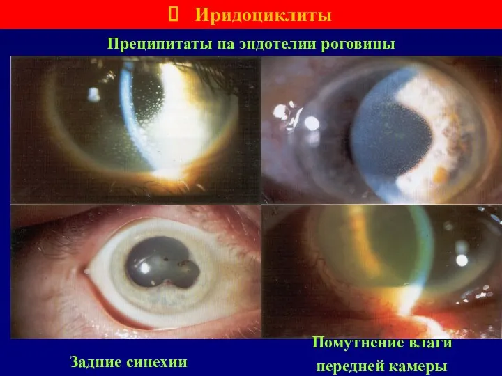 Преципитаты на эндотелии роговицы Иридоциклиты Задние синехии Помутнение влаги передней камеры