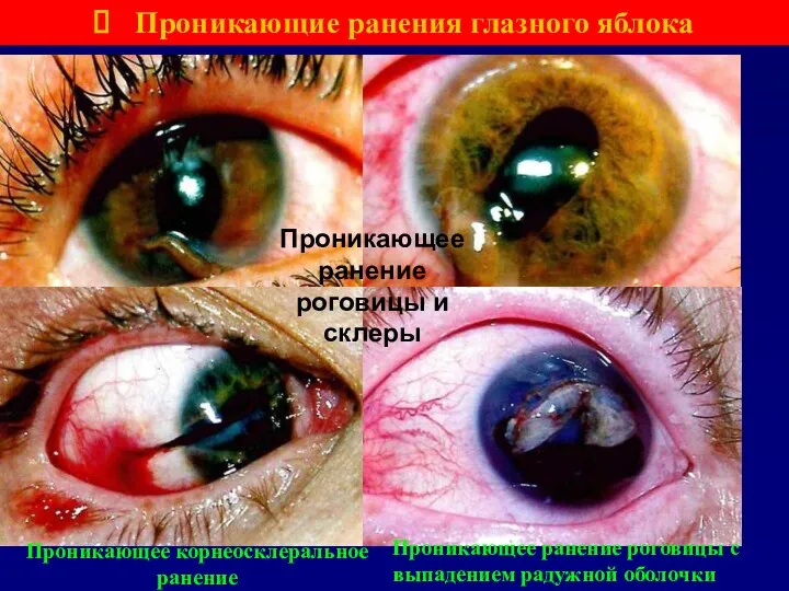 Проникающие ранения глазного яблока Проникающее ранение роговицы и склеры Проникающее