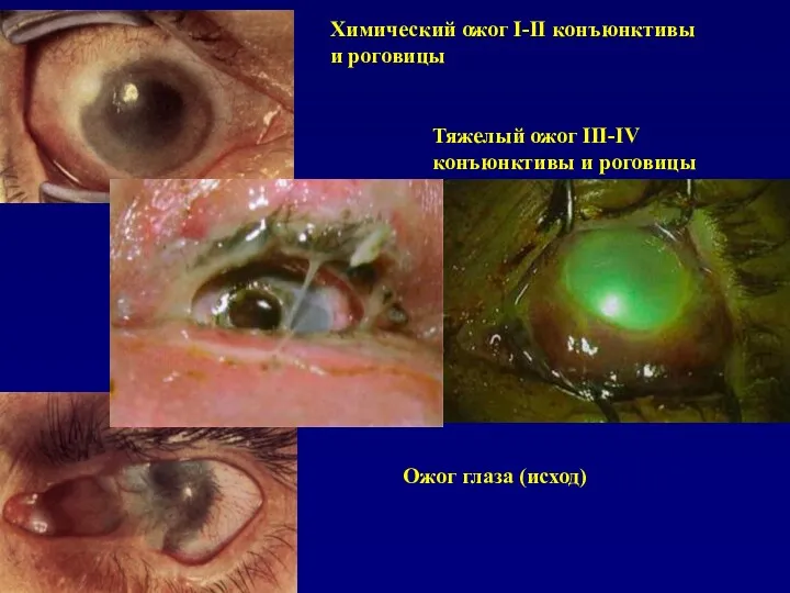 Тяжелый ожог III-IV конъюнктивы и роговицы Химический ожог I-II конъюнктивы и роговицы Ожог глаза (исход)