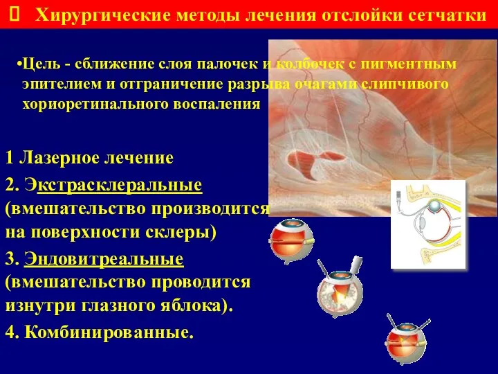 Цель - сближение слоя палочек и колбочек с пигментным эпителием