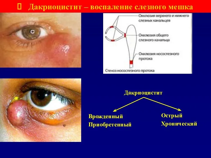 Дакриоцистит – воспаление слезного мешка Острый Хронический Врожденный Приобретенный Дакриоцистит