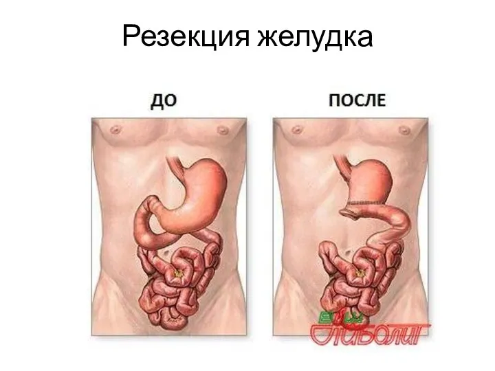 Резекция желудка