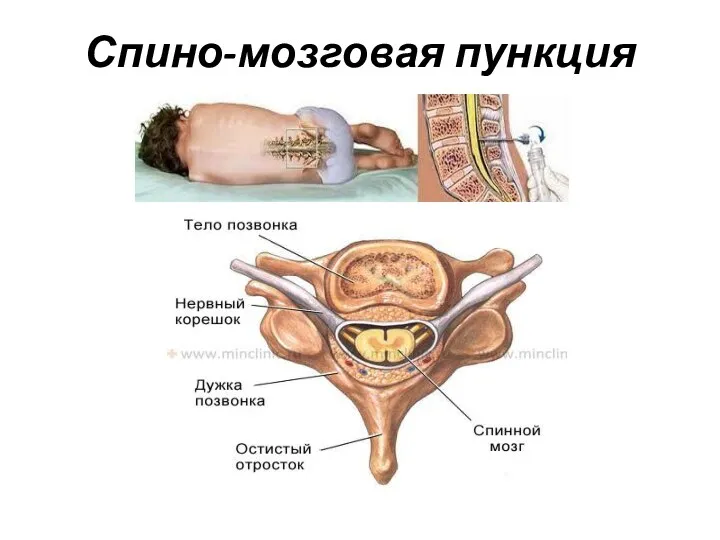 Спино-мозговая пункция