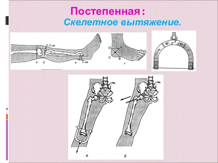 Постепенная: Скелетное вытяжение.