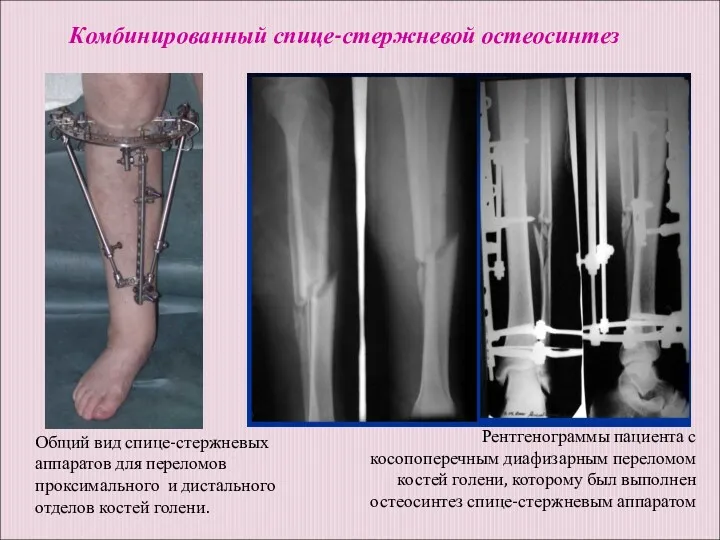 Рентгенограммы пациента с косопоперечным диафизарным переломом костей голени, которому был