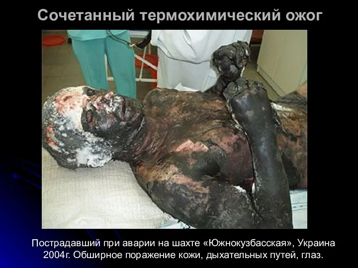 Пострадавший при аварии на шахте «Южнокузбасская», Украина 2004г. Обширное поражение кожи, дыхательных путей,