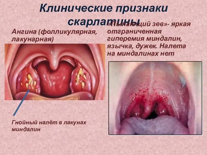 Клинические признаки скарлатины Ангина (фолликулярная, лакунарная) «Пылающий зев»- яркая отграниченная гиперемия миндалин, язычка,