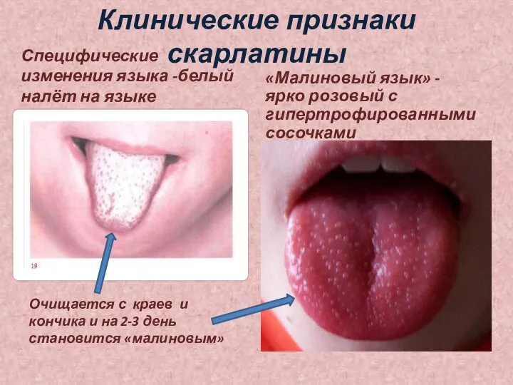 Клинические признаки скарлатины Специфические изменения языка -белый налёт на языке