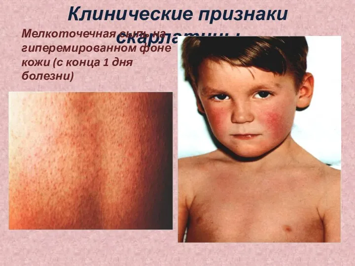 Клинические признаки скарлатины Мелкоточечная сыпь на гиперемированном фоне кожи (с конца 1 дня болезни)