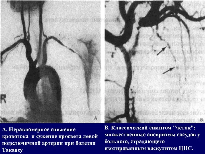А. Неравномерное снижение кровотока и сужение просвета левой подключичной артерии