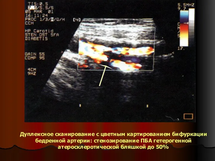 Дуплексное сканирование с цветным картированием бифуркации бедренной артерии: стенозирование ПБА гетерогенной атеросклеротической бляшкой до 50%