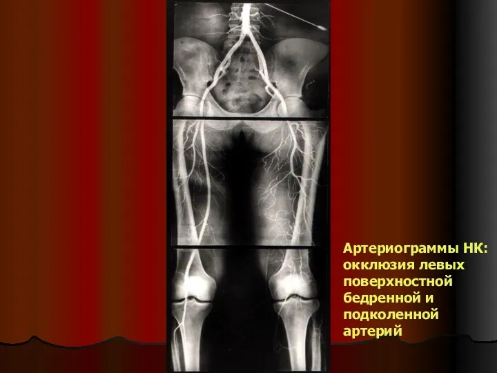 Артериограммы НК: окклюзия левых поверхностной бедренной и подколенной артерий