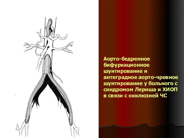 Аорто-бедренное бифуркационное шунтирование и антеградное аорто-чревное шунтирование у больного с