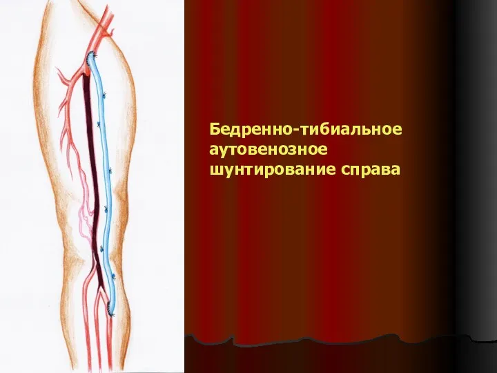 Бедренно-тибиальное аутовенозное шунтирование справа