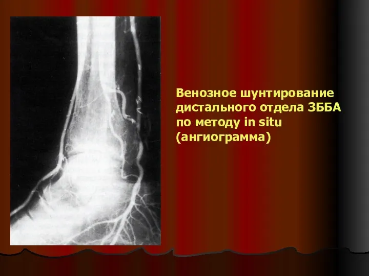 Венозное шунтирование дистального отдела ЗББА по методу in situ (ангиограмма)