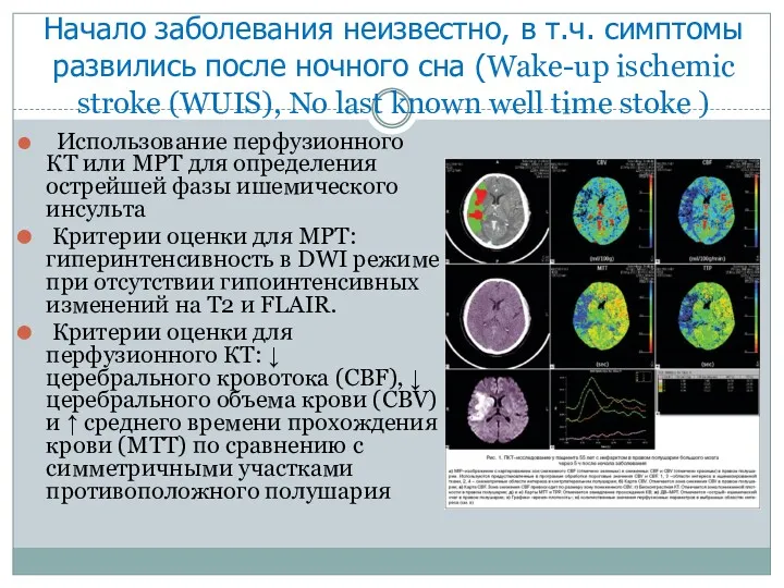 Начало заболевания неизвестно, в т.ч. симптомы развились после ночного сна (Wake-up ischemic stroke