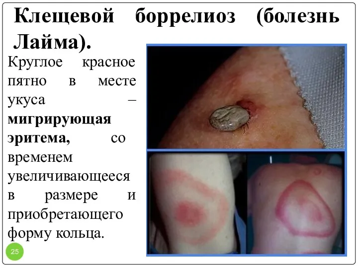 Клещевой боррелиоз (болезнь Лайма). Круглое красное пятно в месте укуса