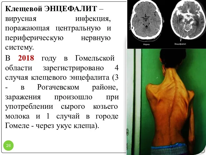 Клещевой ЭНЦЕФАЛИТ – вирусная инфекция, поражающая центральную и периферическую нервную