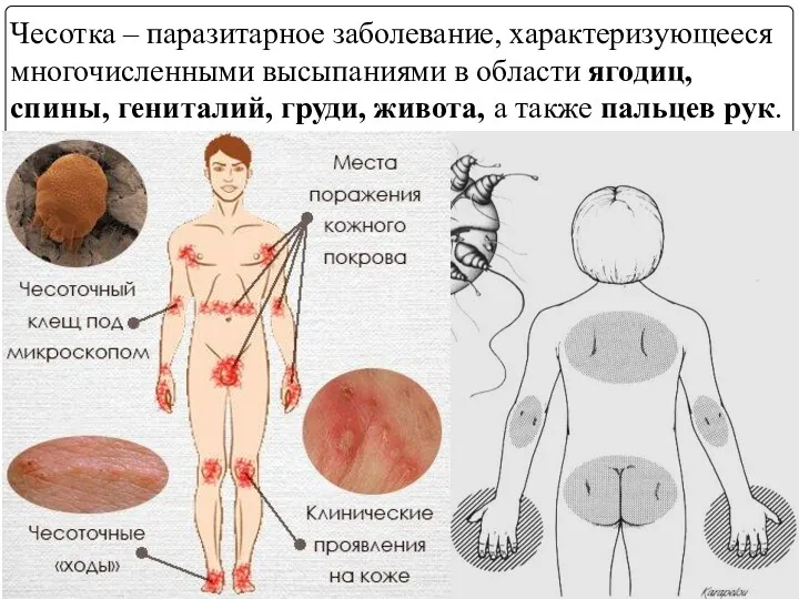 Чесотка – паразитарное заболевание, характеризующееся многочисленными высыпаниями в области ягодиц,