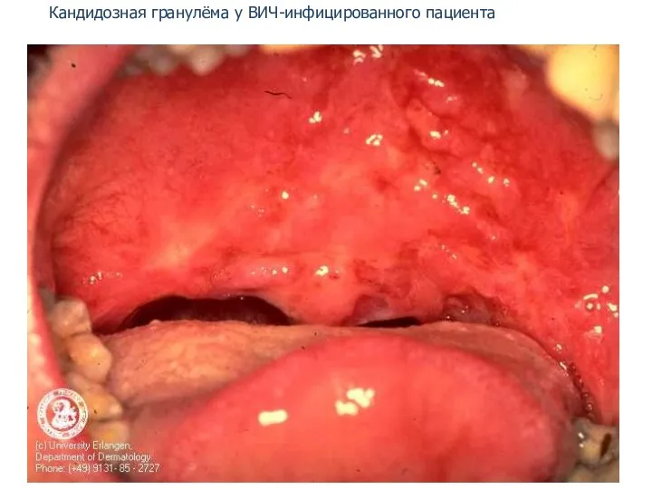 Кандидозная гранулёма у ВИЧ-инфицированного пациента