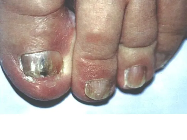 Посттравматическое кровоизлияние в ногтевое ложе. Начальная стадия дистальной формы онихомикоза