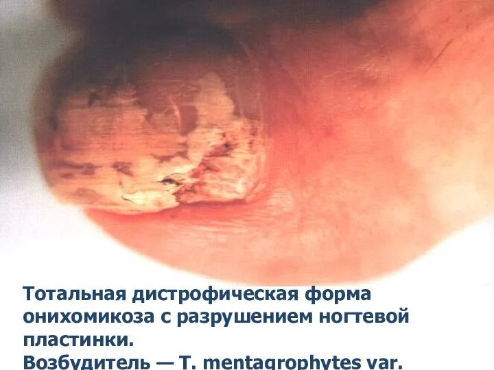 Тотальная дистрофическая форма онихомикоза с разрушением ногтевой пластинки. Возбудитель — Т. mentagrophytes var. interdigitale