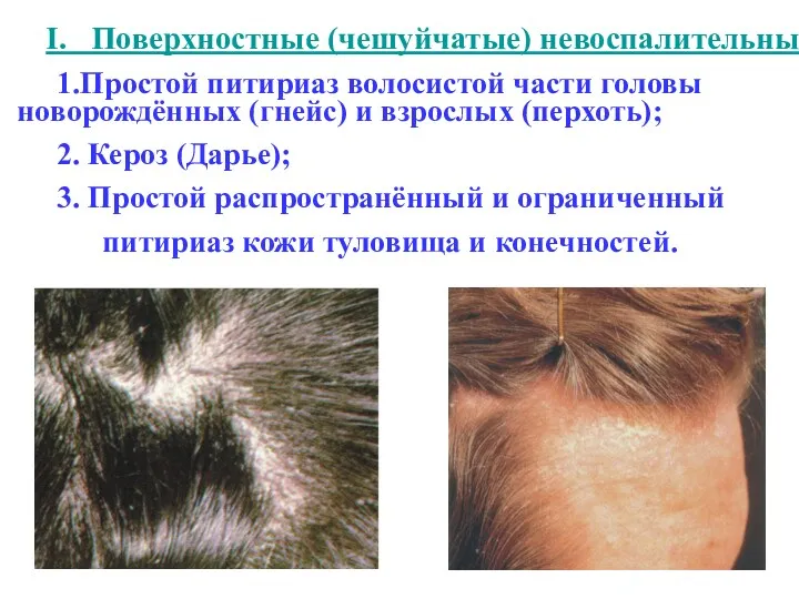 I. Поверхностные (чешуйчатые) невоспалительные: 1.Простой питириаз волосистой части головы новорождённых