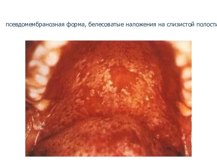 Кандидный стоматит: псевдомембранозная форма, белесоватые наложения на слизистой полости рта