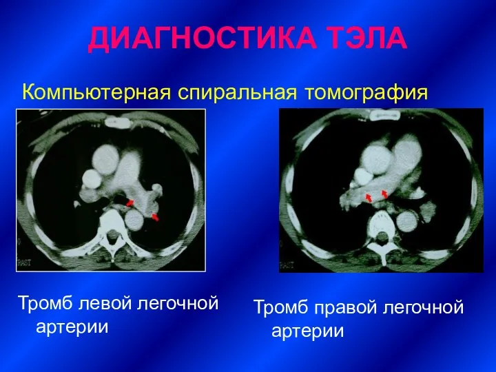 Компьютерная спиральная томография Тромб левой легочной артерии Тромб правой легочной артерии ДИАГНОСТИКА ТЭЛА