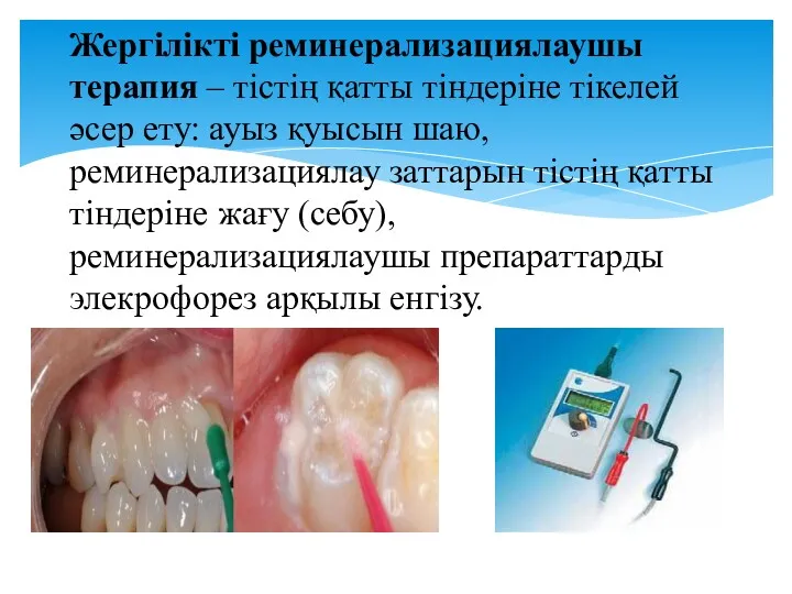 Жергілікті реминерализациялаушы терапия – тістің қатты тіндеріне тікелей әсер ету: