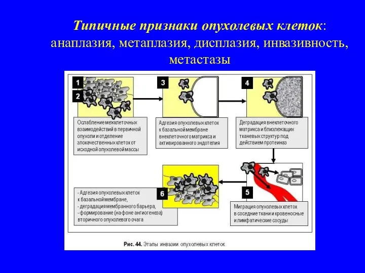 Типичные признаки опухолевых клеток: анаплазия, метаплазия, дисплазия, инвазивность, метастазы