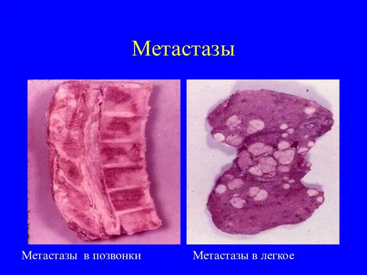 Метастазы Метастазы в позвонки Метастазы в легкое