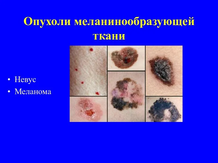Опухоли меланинообразующей ткани Невус Меланома
