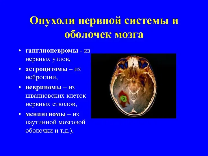 Опухоли нервной системы и оболочек мозга ганглионевромы - из нервных