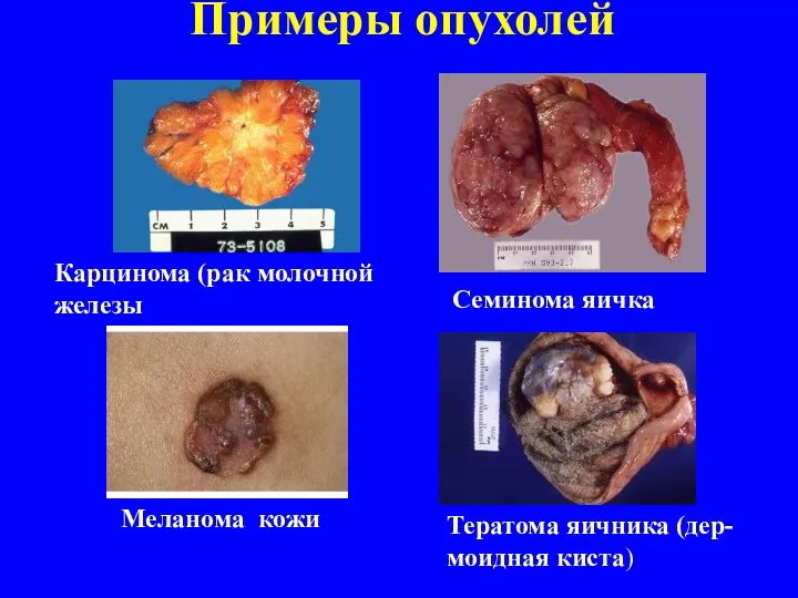 Примеры опухолей Карцинома (рак молочной железы Семинома яичка Меланома кожи Тератома яичника (дер- моидная киста)