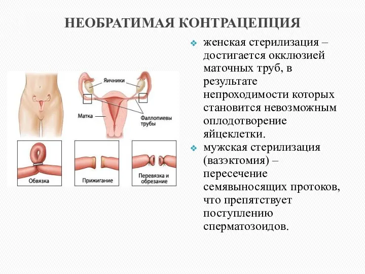 НЕОБРАТИМАЯ КОНТРАЦЕПЦИЯ женская стерилизация – достигается окклюзией маточных труб, в