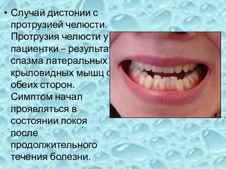 Случай дистонии с протрузией челюсти. Протрузия челюсти у пациентки –