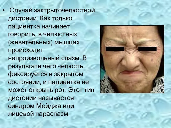 Случай зактрыточелюстной дистонии. Как только пациентка начинает говорить, в челюстных (жевательных) мышцах происходит