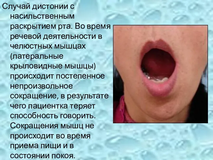 Случай дистонии с насильственным раскрытием рта. Во время речевой деятельности в челюстных мышцах