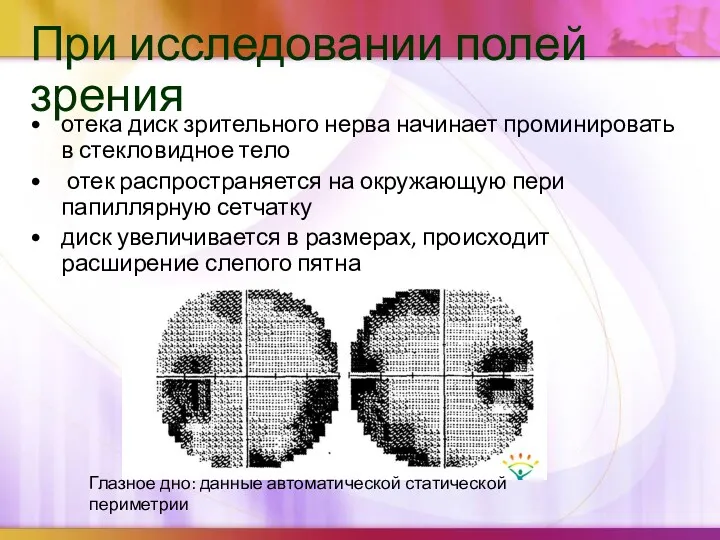 При исследовании полей зрения отека диск зрительного нерва начинает проминировать