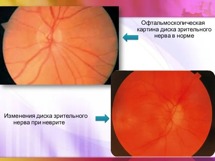 Офтальмоскопическая картина диска зрительного нерва в норме Изменения диска зрительного нерва при неврите