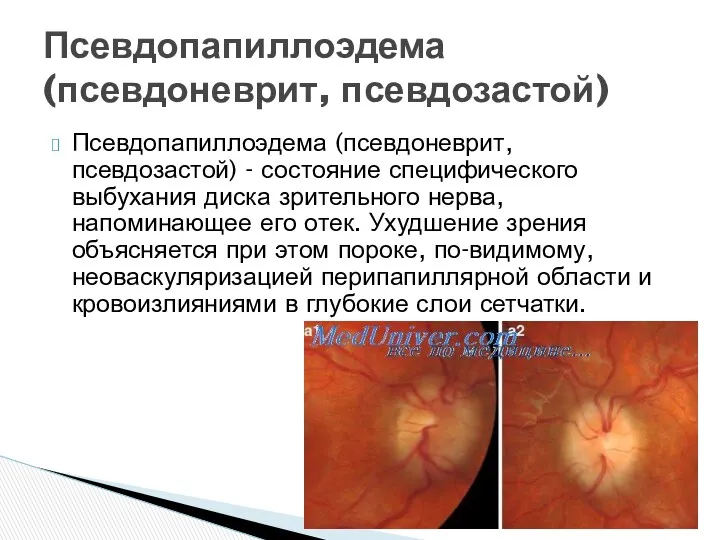 Псевдопапиллоэдема (псевдоневрит, псевдозастой) - состояние специфического выбухания диска зрительного нерва,