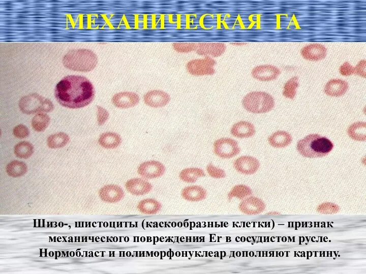 МЕХАНИЧЕСКАЯ ГА Шизо-, шистоциты (каскообразные клетки) – признак механического повреждения
