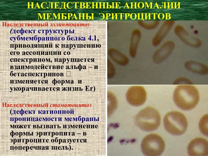 НАСЛЕДСТВЕННЫЕ АНОМАЛИИ МЕМБРАНЫ ЭРИТРОЦИТОВ Наследственный эллиптоцитоз (дефект структуры субмембранного белка