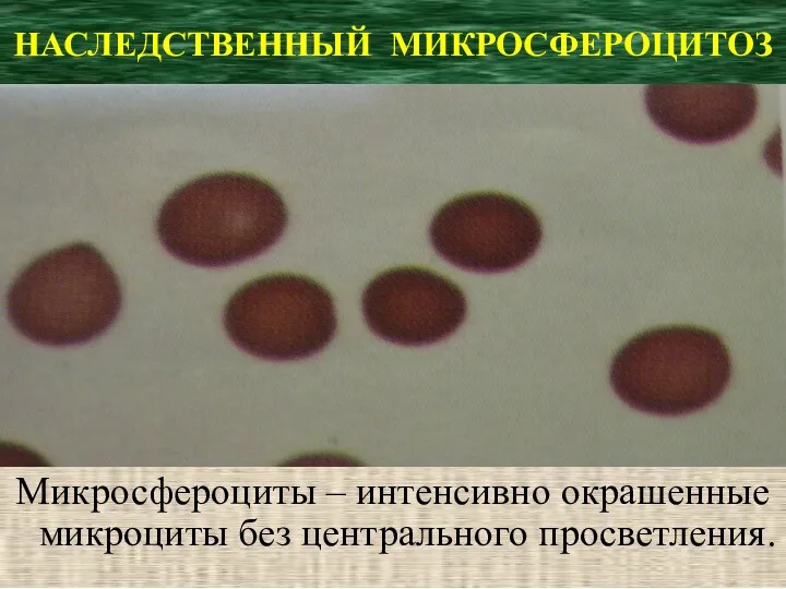 НАСЛЕДСТВЕННЫЙ МИКРОСФЕРОЦИТОЗ Микросфероциты – интенсивно окрашенные микроциты без центрального просветления.