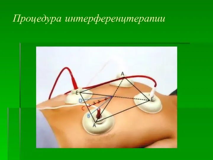 Процедура интерференцтерапии