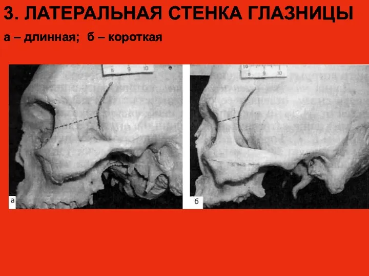 3. ЛАТЕРАЛЬНАЯ СТЕНКА ГЛАЗНИЦЫ а – длинная; б – короткая