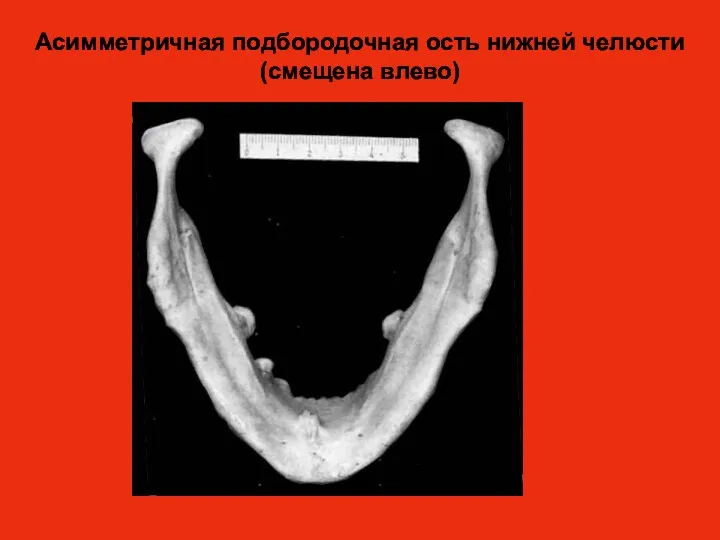 Асимметричная подбородочная ость нижней челюсти (смещена влево)