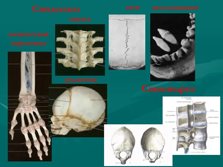 межкостная перепонка связка шов вколачивание родничок Синхондроз Синдесмоз