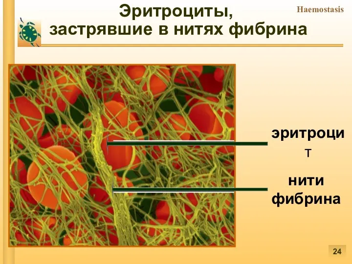 Эритроциты, застрявшие в нитях фибрина нити фибрина эритроцит